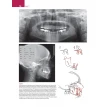 Мини-имплантаты. Ортодонтия будущего. Франсуа Дарке. Скандер Эллуз. Фото 31
