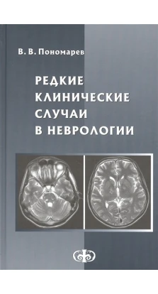 Редкие клинические случаи в неврологии (случаи из практики). Руководство для врачей. Владимир Пономарев